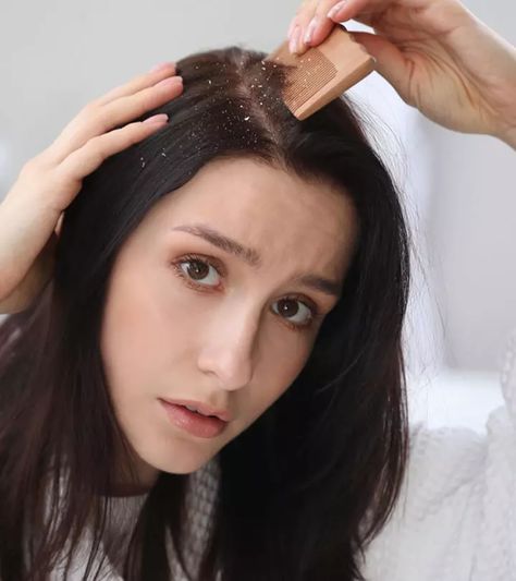 What Causes Dandruff, And How To Treat It What Causes Dandruff, Dandruff Causes, Glowing Skin Makeup, Hair Dandruff, Castor Oil For Hair, Vitamins For Hair Growth, Makeup Tips For Beginners, Hair Vitamins, Eye Makeup Tips