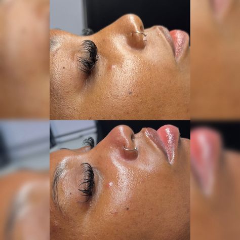 Before and after a Dermaplane facial ☁️☁️ Dermaplane Facial, Facial, Quick Saves