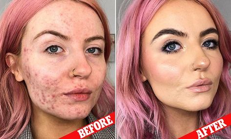 Women are praising this foundation for COMPLETELY covering their acne - and it only costs $18 | Daily Mail Online Acne With Makeup, Makeup For Acne, Spotty Face, Acne Coverage, Acne Concealer, Covering Acne, Acne Makeup, Acne Problem, Acne Spots