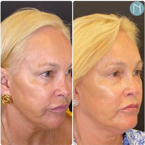 Our non-surgical Fotona 4D Facelift does it again!! Aging in reverse is possible and is easer than you may think with minimal discomfort and little to no down-time between treatments. ☎️Call today to book your complimentary consultation. 561-240-3000 #injectables #botox #fillers #medspa #restylane #dysport #laser #lasertreatments #nonsurgicalskintightening #fotona4d #fotona #medicalspa #jupiter #palmbeach #boca #delray #westpalmbeach #ageinreverse #collagen #facelift #westpalm #bestofthebest Botox Fillers, Medical Spa, Med Spa, West Palm, West Palm Beach, Palm Beach