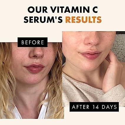 Vitamin C Face Serum - Hyaluronic Acid, Retinol, & Vit E - Anti Aging Facial Brightening Serum for Skin Care - Timeless Pure Vitamin C Serum for Face Dark Spots, Vit C Serum Oil Vitamin C Face Serum, Dark Spots On Face, Vit C, Anti Aging Facial, Hyaluronic Acid Serum, Skin Care Serum, Skin Serum, Vitamin C Serum, Brightening Serum