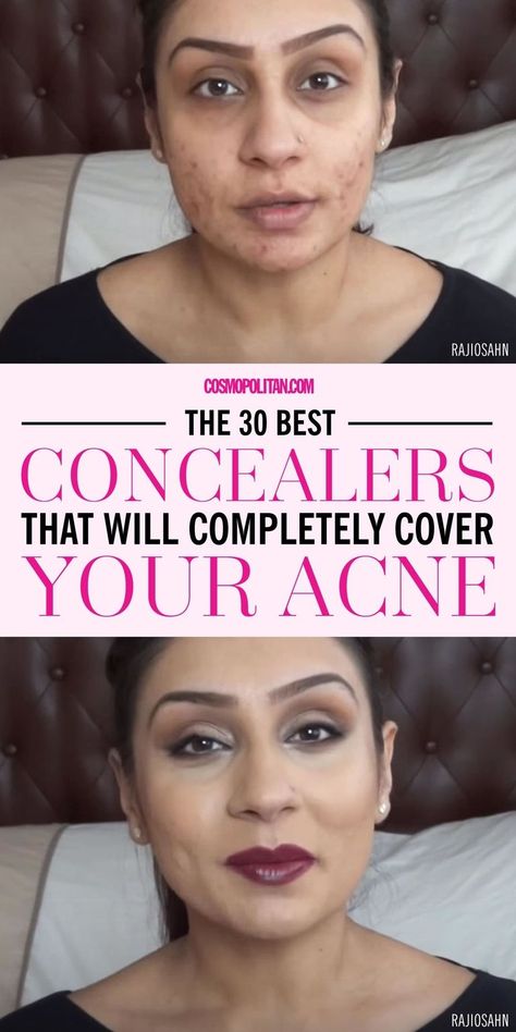 concealer Makeup For Acne Prone Skin, Best Concealer For Acne, Concealer Products, Makeup For Acne, Best Concealers, Skin Care For Oily Skin, Apply Concealer, Summer Beauty Tips, Skin Care For Acne