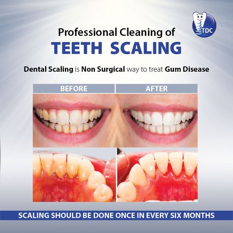 Prevent #toothdecay, prevent #gum disease! #Scaling removes plaque and calculus from the #teeth and below the gums.  *Scaling should be done once in every six months Dental Awareness Posters, Dental Awareness, Dental Scaling, Dental Ads, Dental Advertising, Dental Images, Dental Posts, Dental Posters, Dentist Clinic