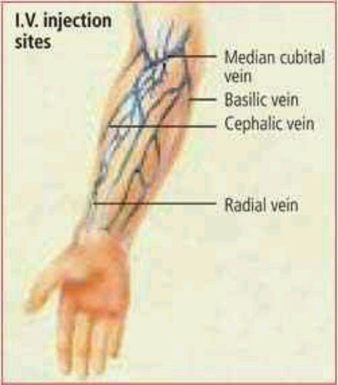 IV Injection Sites Iv Injection, Nursing Iv, Iv Insertion, School Problems, Injection Sites, Nursing Knowledge, Nurse Education, Iv Solutions, Nursing School Problems