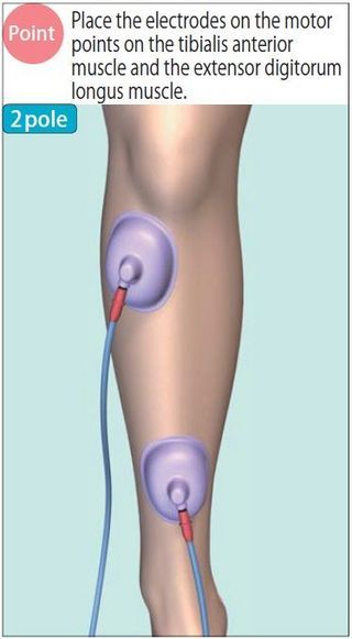 Chapter 5 Therapeutic points in NMES (neuromuscular electrical stimulation) mode｜Rehabilitation & Physiotherapy | NIHON MEDIX CO., LTD. Neuromuscular Therapy, Rectus Abdominis Muscle, Job Loss, Healthcare Jobs, Lower Extremity, Abdominal Muscles, Health Care, Medical, Electricity