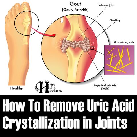 Herbs Health & Happiness How To Remove Uric Acid Crystallization In Joints - Herbs Health & Happiness Uric Acid Remedy, Uric Acid Food, Uric Acid Crystals, Uric Acid Levels, Synovial Fluid, Endocrine Disorders, Uric Acid, Medication Management, Natural Cold Remedies