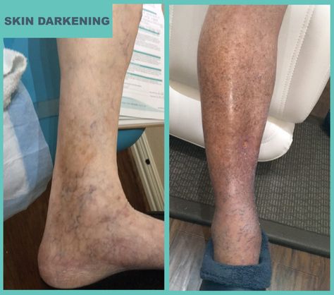 Skin Darkening Leg Circulation Remedies, Dark Spots On Legs, Autoimmune Disease Symptoms, Best Dark Spot Corrector, Skin Darkening, Spots On Legs, Venous Insufficiency, Swollen Ankles, Flaking Skin