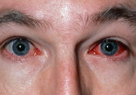 Viral Conjunctivitis - Etiology, pathophysiology, symptoms, signs, diagnosis & prognosis from the Merck Manuals - Medical Professional Version. Weird Things People Do, Eye Diseases, Eye Infections, Dark Underarms, Lymph Nodes, Sinus Infection, Eyes Problems, Eye Drops, Pink Eyes