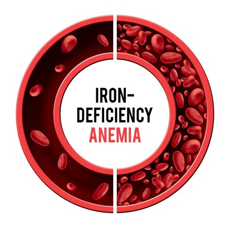 Iron Mineral, Women Wellness, Grapes Benefits, Fitness Books, Yoga Information, Iron Supplement, Vitamin B12 Deficiency, Foods High In Iron, Iron Deficiency