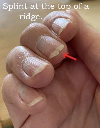 Vertical Ridges On Fingernails, Fingernail Ridges, Nail Ridges, Split Nails, Grow Nails Faster, Hiding Ugly, Nail Problems, Nail Growth, Heart Problems