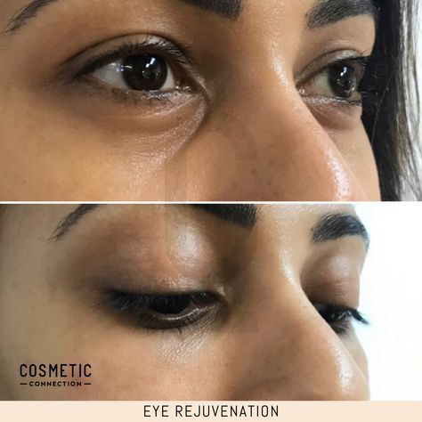 Eye Rejuvenation Purpose: Improve the appearance of the eye-region How it works: Injections using dermal filler and/or anti-wrinkle. Time it takes: 10-20 minutes Downtime: None Maintenance: Revisit 12-24 months on average Discomfort: Minimal, numbing options available Price: Please see website for our current pricing Suitability: 18+. Not suitable if you’re pregnant or breastfeeding Caution: Must be performed by an experienced, registered practitioner Hollow Under Eyes, Eye Rejuvenation, Under Eye Filler, Under Eye Fillers, High Blood Sugar Symptoms, Tear Trough, Remove Dark Circles, Under Eyes, Dermal Fillers