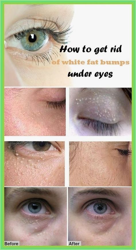 How To Get Rid of White Fat Bumps Around Eyes Naturally Bumps Under Eyes, Healthy Advice, Under Eyes, Dark Circles Under Eyes, Skin Care Treatments, Health And Beauty Tips, Belleza Natural, Dark Circles, Beauty Secrets