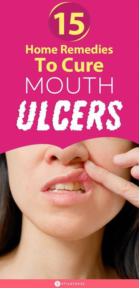 #GoodOralHealth How To Get Rid Of Mouth Ulcers, Ulcer Remedies, Ulcer On Tongue, Ulcer Remedies Mouth, Toddler Tooth Decay, Baby Tooth Decay, Tooth Decay Remedies, Swollen Tongue, Snacks Easy