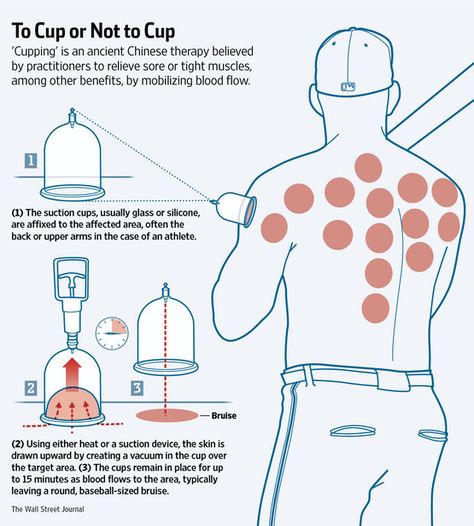 Cupping Therapy, Cupping Points, Chinese Cupping, Benefits Of Cupping, Hijama Cupping, Fire Cupping, Acupuncture Benefits, Cupping Massage, Massage Therapy Techniques, Cupping Therapy