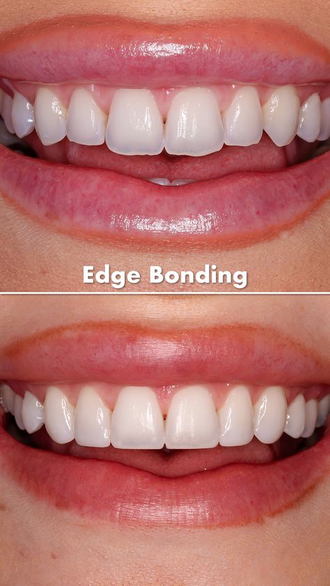 Mouth With Braces, Chipped Tooth Repair, Teeth After Braces, Draw A Mouth, Teeth Bonding, Composite Veneers, Chipped Tooth, Dental Bonding, Tooth Repair