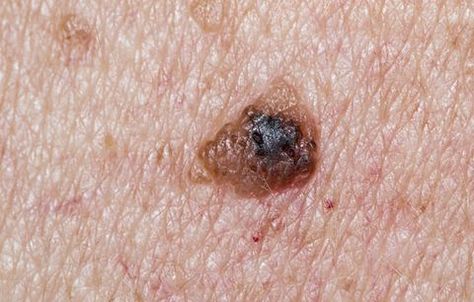 image Black Mole, Cancerous Moles, Basal Cell, Skin Moles, Types Of Cancers, Layers Of Skin, Normal Skin, Mens Health, Warning Signs