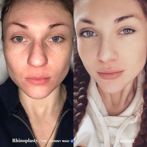 Rhinoplasty Swelling Progression, Bulbous Nose Rhinoplasty Before After, Rhinoplasty Recovery Timeline, Bulbous Nose Rhinoplasty, Nose Plastic Surgery, Rhinoplasty Recovery, Swollen Face, Nasal Wash, Bulbous Nose