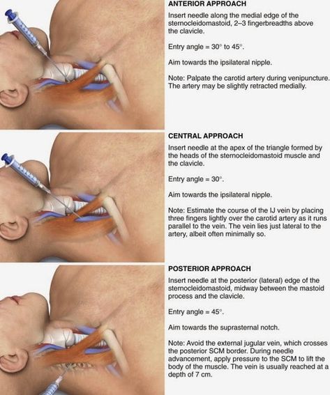 Approach to the Internal Jugular Vein.  Click image to enlarge. Central Line Catheter, Jugular Vein, Emt Study, Medical Terminology Study, Central Line, Carotid Artery, Basic Anatomy And Physiology, Medical Videos, Critical Care Nursing