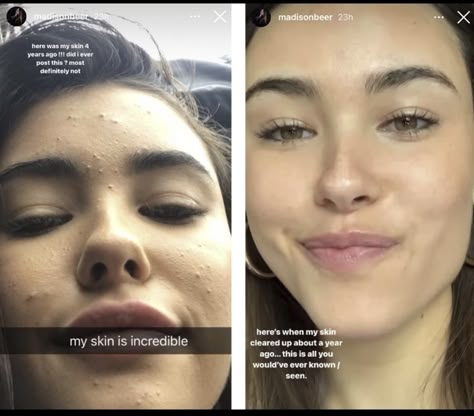 Madison Beer Makeup, Madison Beer Instagram, Acne Positivity, Beer For Hair, Real Skin, Perfect Skin Care Routine, Face Acne, Pretty Skin Care, Pretty Skin