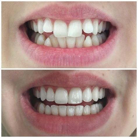 What a beautiful transformation 😃💜 #smilemakeover Sensitive Teeth Remedy, Dental Videos, Heal Cavities, Veneers Teeth, Dental Art, Botox Injections, Best Teeth Whitening, Dental Surgery, Sensitive Teeth