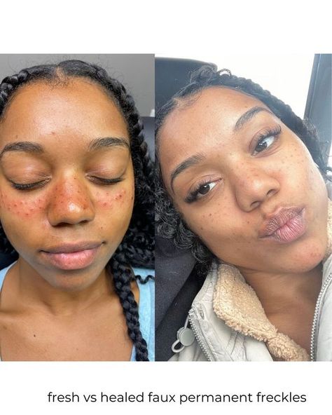 Freckle Face Tattoo, Semi Permanent Freckles, Stick And Poke Freckles, Freckle Tattoo Before And After, Light Skin With Freckles, Makeup For Freckled Skin, Baby With Freckles, Tattoo Freckles, Freckles Tattoo