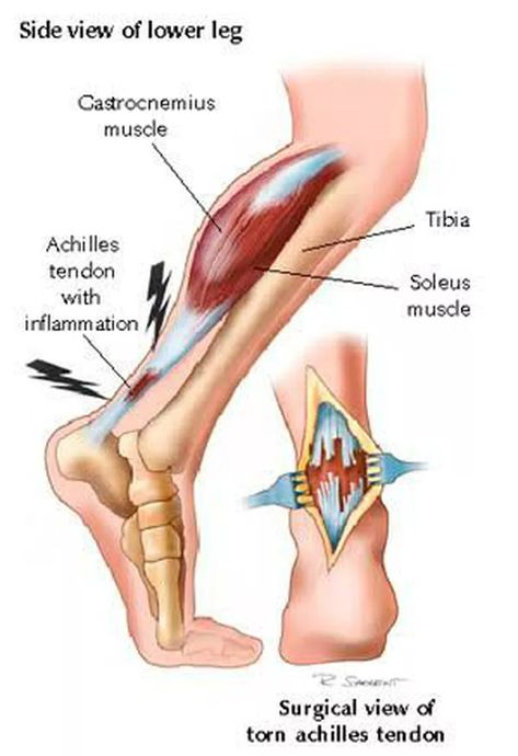 Achilles tendon rupture - MEDizzy Middle Back Pain Causes, Strength Exercises For Runners, Achilles Tendon Ruptures, Lower Back Pain Remedies, Lower Back Pain Causes, Muscle Inflammation, Pregnancy Back Pain, Obese Workout, Hip Strengthening Exercises