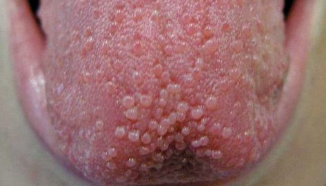 Tongue Bumps: How to Get Rid of Them Lie Bumps On Tongue, Bumps On Tongue, Ulcer On Tongue, Tongue Sores, Homemade Mouthwash, Tongue Health, Nail Care Tips, Nail Health, Cotton Ball