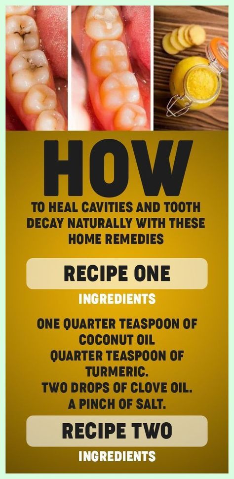 Heal Cavities, Teeth Health, Receding Gums, Home Health Remedies, Cold Home Remedies, Oral Health Care, Natural Health Remedies, Tooth Decay, Natural Home Remedies