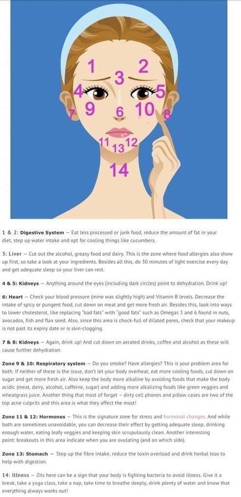 acne's location on the face, and what it means. Doterra Acne, Gesicht Mapping, Face Mapping Acne, Face Mapping, Acne Causes, Acne Problem, Face Acne, Acne Remedies, How To Get Rid Of Acne