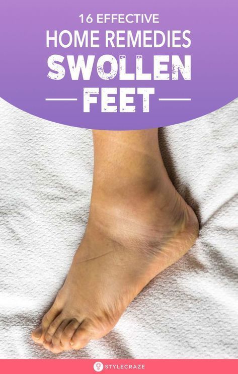 Sore Feet Remedies, Swelling Remedies, Swollen Feet Remedies, Feet Remedies, Natural Headache, Swollen Ankles, Natural Headache Remedies, Swollen Legs, Back Pain Remedies