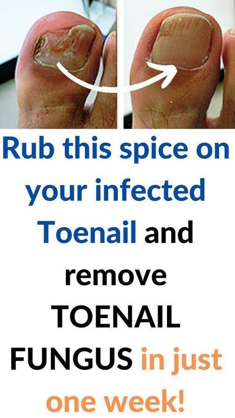 People go crazy for his recipe! toenail fungus remove in just one week!#killsnail #treatmentfungus #nailfungus #toenailfungus #fungus #fungustretment #fungustoenail Infected Toenail, Toenail Fungal Infection, Nail Remedies, Fingernail Fungus, Toenail Fungus Remedies, Nail Fungus Remedy, Nail Infection, Fungal Nail, Toenail Fungus