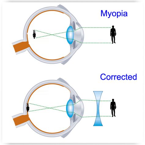 Eye Health Facts, Physical Science Lessons, Eye Vision, Physics Lessons, Eye Care Center, Learn Physics, Physics Classroom, Eye Anatomy, Basic Anatomy And Physiology