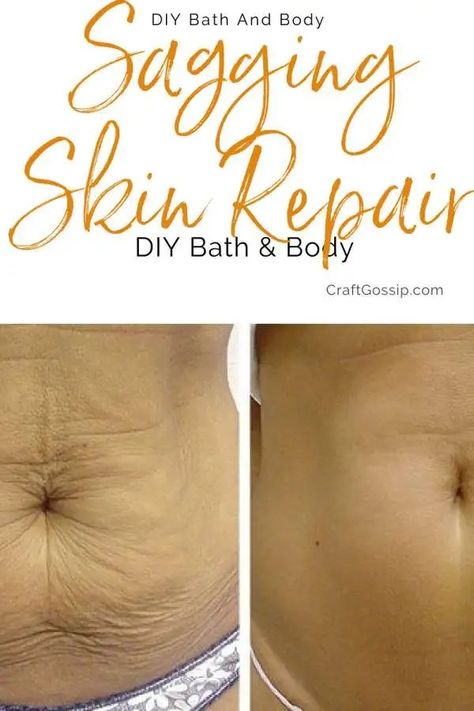 10 Tricks To Tighten Your Skin After Weightloss – Bath and Body Belly Skin Tightening, Sagging Belly, Diy Skin Tightening, Tighten Stomach, Sagging Cheeks, Natural Skin Tightening, Loose Belly, Tighten Loose Skin, Saggy Skin