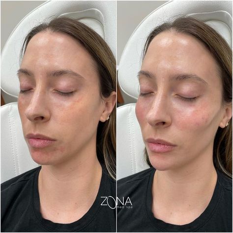 ZONA Med Spa on Instagram: "Restoring volume in the mid face and creating more of a point in the chin = upside down youthful triangle 🔻 Cheeks and chin filler compliment each other nicely! Slide to check out these amazing before and afters ⏩ Get cheeks and chin filler for as low as $240/month* with Cherry Financing. To see what you qualify for or to book an appointment click our link in bio 👆🏻 *subject to approval withCherry, terms may vary. _____________________________________ #cheekfiller Chin Filler, Chin Augmentation, Cheek Fillers, Turmeric Health, Vintage Pop Art, Wax Strips, Juicy Lips, Natural Pain Relief, Long Faces