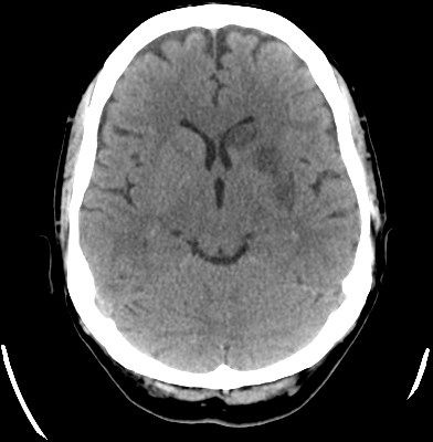 Objective: We report a new case of isolated micrographia due to stroke involving the lenticular nucleus. Background: Micrographia is a common sign in Parkinson´s disease while is a rare but recognised manifestation of an acute brain lesion commonly located in the left basal ganglia region. Methods: Case report. Results: We report a 57 year old […] Caudate Nucleus, Basal Ganglia, Assessment, Disease, Year Old, Brain