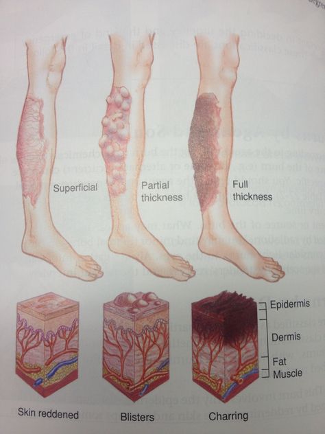 Classifications of burns. Burn Wounds Reference, Burned Skin Reference, Burn Reference, Burn Marks Reference, Burn Wound, Nursing Pins, Skin Burns, Burn Mark, Medical Anatomy