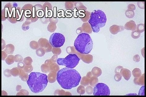 Myeloblasts Microbiology Lab, Medical Laboratory Scientist, Abnormal Cells, Medicine Notes, Medical Laboratory Science, Medical School Motivation, Medical Laboratory, Laboratory Science, Bone Marrow