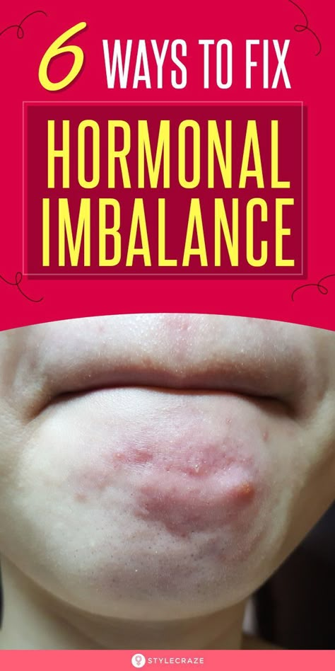 Fix Hormonal Imbalance, Women Problems, Low Estrogen Symptoms, Too Much Estrogen, Get Rid Of Pimples, Rid Of Pimples, Womens Health Care, Hormonal Imbalance, Women Health Care