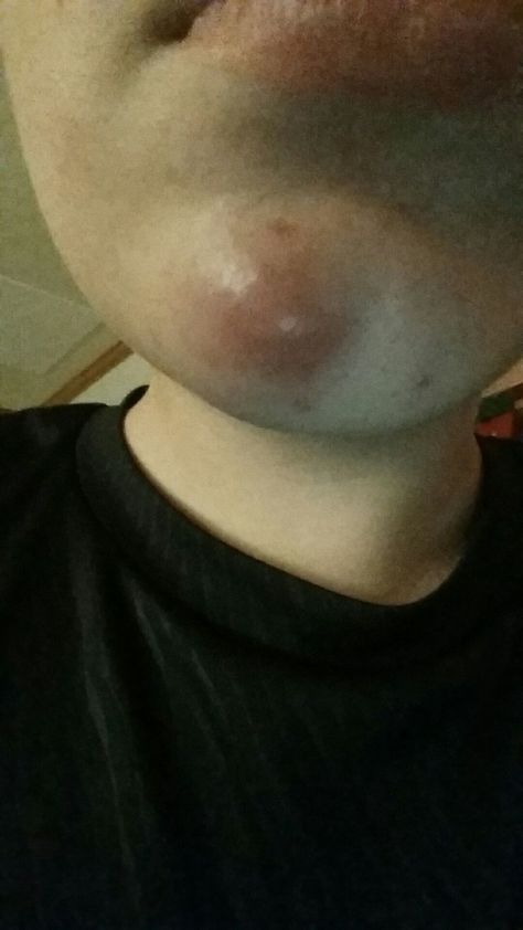 I have this HUGE pimple on my chin and it is quite painful. Does anyone have a remedy? Zit Remedy, Huge Pimple, Painful Pimple, Big Pimple, How To Get Rid Of Pimples, Healthy Juice Recipes, Ingrown Toe Nail, Kylie Cosmetics, Useful Life Hacks