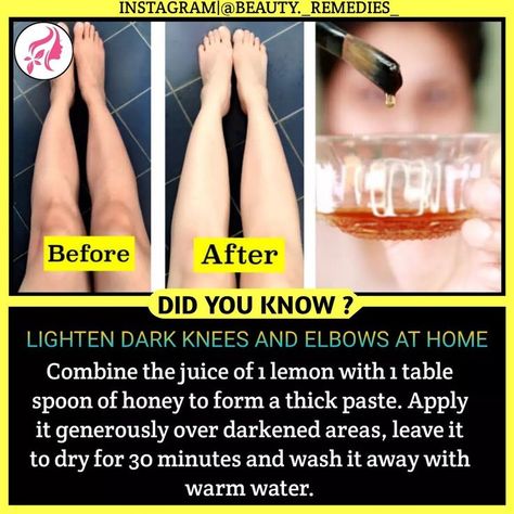 Dark Knees And Elbows, Dark Knees, Food For Eyes, Clear Skin Fast, Diy Serum, Leg Scrub, Skin And Hair Clinic, Home Remedies For Skin, Natural Skin Care Ingredients