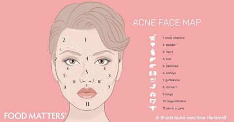 Stop ignoring acne- your face can tell you how healthy your body is. Instead of covering pimples up with makeup, learn how to find out if the real problem is your liver, your hormones or something else. Gesicht Mapping, Face Mapping Acne, Detox Kur, Body Toxins, Pimples On Face, Face Mapping, Acne Causes, Face Acne, Beauty Face Women