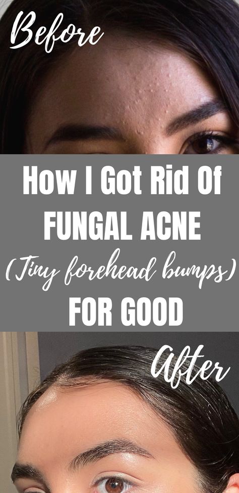 Skin Bumps On Face, Small Bumps On Face, Forehead Bumps, Pimples On Forehead, Acne Clearing, Clear Skin Care, Fungal Acne, Forehead Acne, Pimples Under The Skin