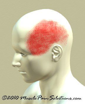 Temple headache Temple Headache, What Causes Headaches, Tension Headache Relief, Neck Pain Exercises, Headache Causes, Throbbing Headache, Headache Types, Improve Nutrition, Muscle Massage