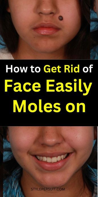 Moles are common skin growths that can appear anywhere on the body, including the face. While most moles are harmless, some people may choose to remove them for cosmetic reasons or if they become irritated. If you're wondering how to get rid of moles on your face, click to discover natural remedies and tips to get rid of moles on face Moles On Face, Red Moles, Holey Moley, Talking Behind Your Back, Skin Moles, Beauty Marks, Skin Growths, Natural Hair Mask, Mole Removal