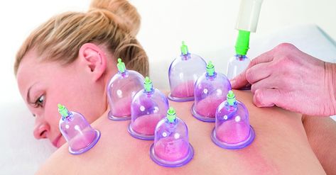 The Emerging Science on the Benefits of Cupping What Is Cupping Therapy, Wet Cupping, Benefits Of Cupping, Healthy Community, Fire Cupping, Cupping Massage, How To Relieve Migraines, Cupping Therapy, Holistic Care