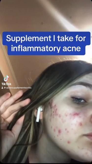 Clear Skin Vitamins, Vitamins For Clear Skin, Natural Remedies For Acne, Acne Supplements, Back Acne Remedies, Inflammatory Acne, Remedies For Acne, Skin Vitamins, Skin Supplements