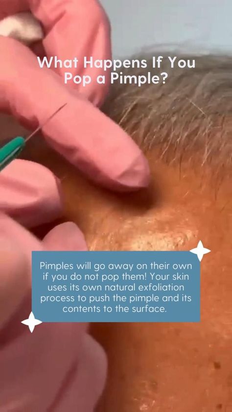 Painful Pimple, Blind Pimple, Acne Skincare Routine, How To Get Rid Of Pimples, Acne Solutions, Natural Exfoliant, Acne Care, Acne Skin, Skin Care Acne