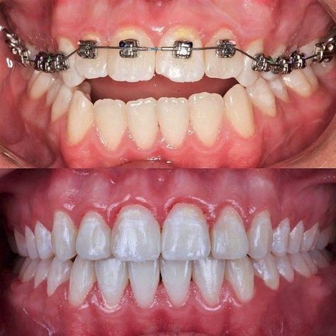 Dentist Aesthetic, Braces Before And After, Dental Bridge Cost, Braces Smile, Dental Images, Family Dental Care, Dental Posters, Traditional Braces, Dental Implants Cost