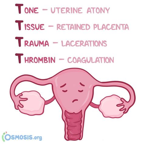 Osmosis on Instagram: “Postpartum hemorrhage is excessive bleeding following the birth of a baby. Use this 4T mnemonic to help you remember the causes of…” Postpartum Hemorrhage Nursing, Post Partum Hemorrhage, Pediatric Nursing Study, Disseminated Intravascular Coagulation, Postpartum Hemorrhage, Nursing Things, Nurse Notes, Assistant Nurse, Newborn Nursing