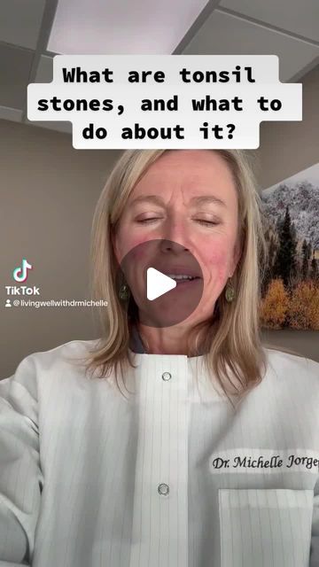 Dr. Michelle Jorgensen, DDS, BCTN, TNC on Instagram: "This reel is to help provide some answers.  It answers 2 questions: 1 - What are tonsil stones #2 - What can you do about them?  #tonsilstones #tonsils #tonsillectomy #naturalhealing #calcium #calciumdeposit" Tonsil Stone Remedies, Tonsil Stones What Causes, How To Get Rid Of Tonsil Stones, Tonsil Stones Removal, Tonsil Stone Removal, Tonsil Stone, Calcium Deposits, Surgery Gift, Coping Mechanisms